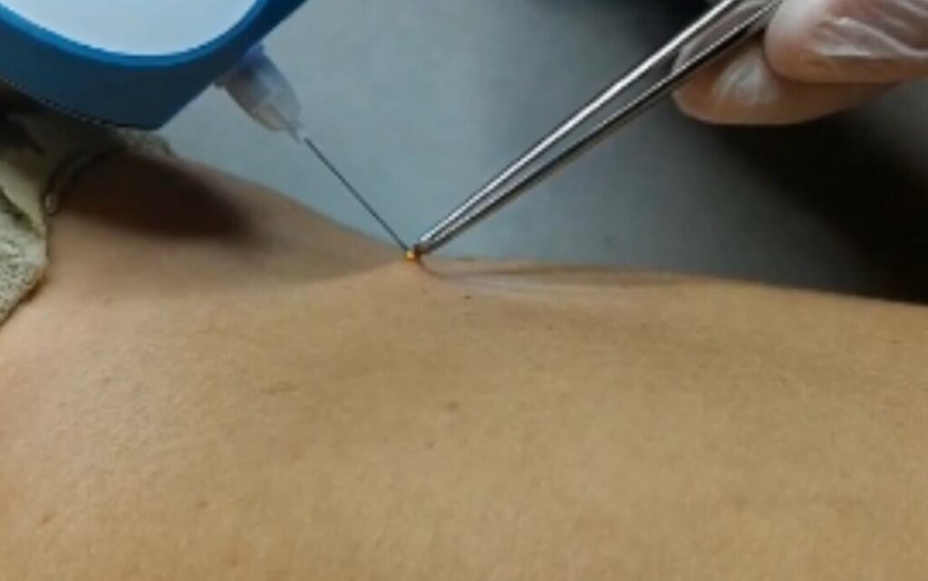 How to Remove Skin Tags Safely in Bradford